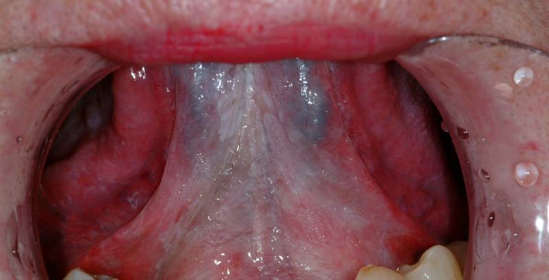 سرطان زبان