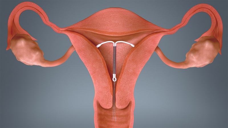 IUD برای جلوگیری از بارداری