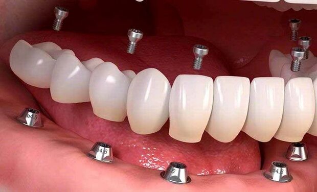 دندان مصنوعی ثابت 