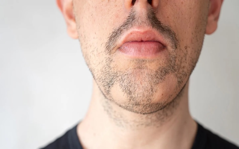 درمان ضایعات پوستی و ارتباط ان باریزش سکه ای