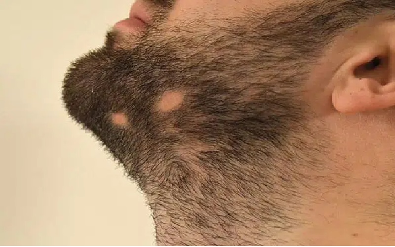 روش های تحریک پوست