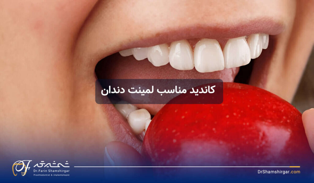 لمینت دندان