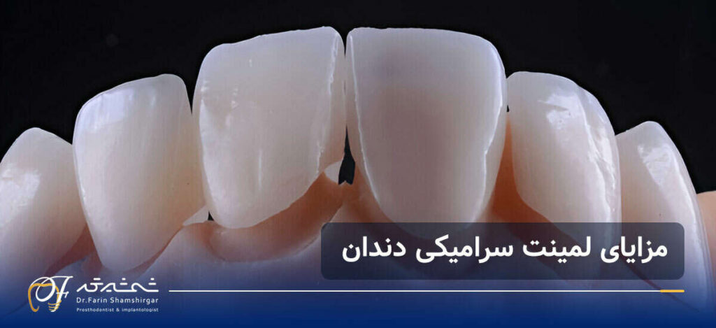 مزایا لمینت دندان