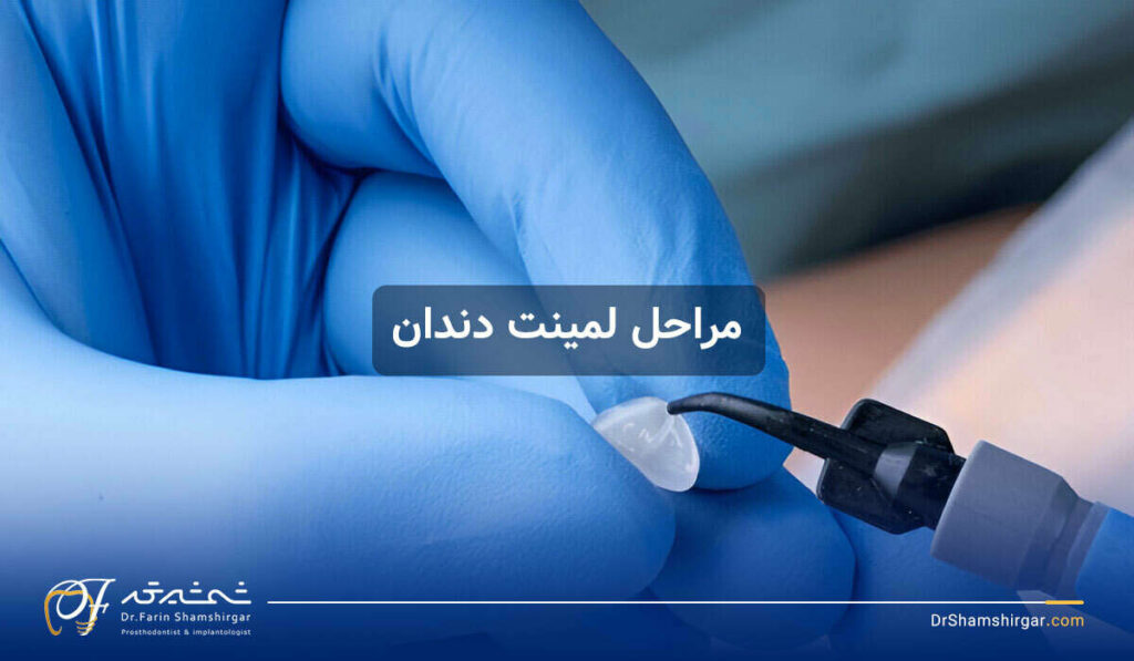 مراحل لمینت دندان