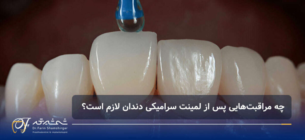 مراقبت های بعد از لمینت دندان