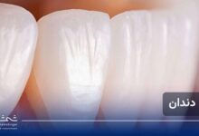 لمینت دندان چیست؟ راهنمای کامل مزایا، معایب و هزینه لمینت برای لبخندی بی‌نقص