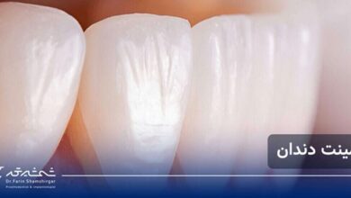 لمینت دندان چیست؟ راهنمای کامل مزایا، معایب و هزینه لمینت برای لبخندی بینقص