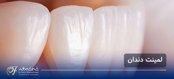 لمینت دندان چیست؟ راهنمای کامل مزایا، معایب و هزینه لمینت برای لبخندی بی‌نقص