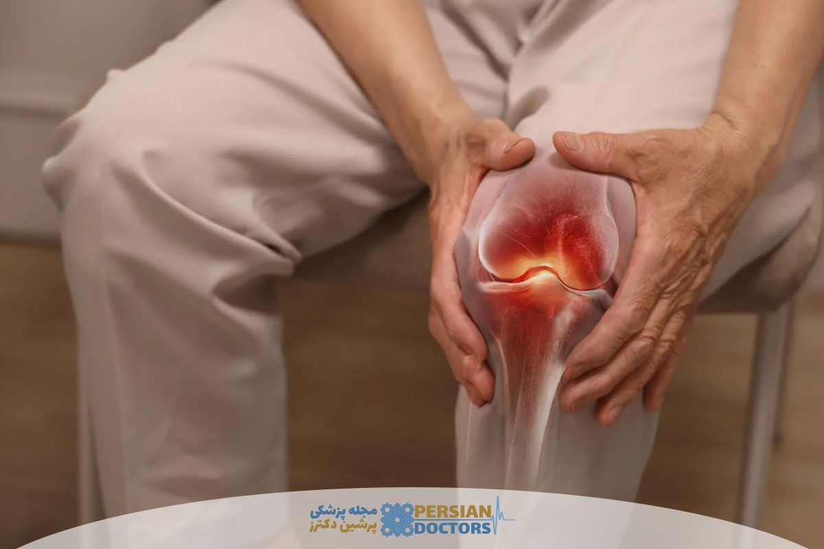 بهترین روش درمان آرتروز زانو بدون عمل جراحی