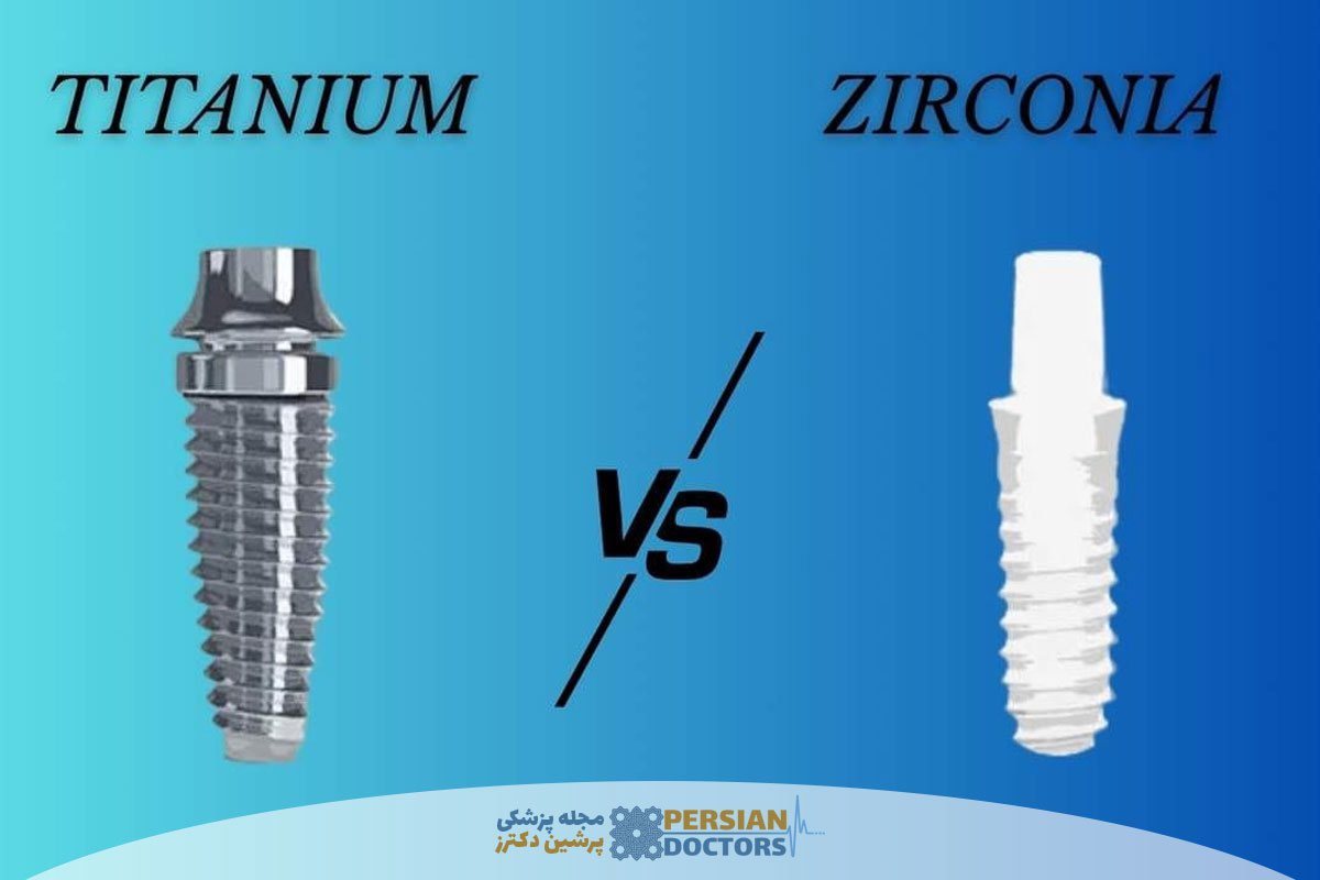 تفاوت ایمپلنت زیرکونیا با تیتانیوم چیست و کدام ماندگاری بیشتری دارد؟