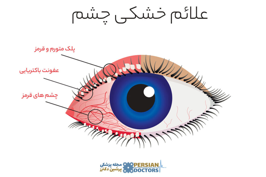 علائم خشکی چشم