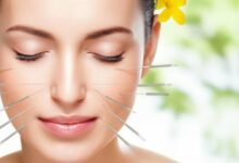 خواص طب سوزنی برای صورت