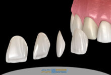 لمینت سه بعدی دندان چیست و چرا به راه حل محبوب زیبایی لبخند تبدیل شده است