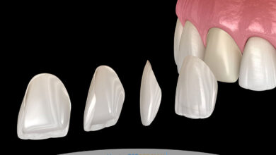 لمینت سه بعدی دندان چیست و چرا به راه حل محبوب زیبایی لبخند تبدیل شده است