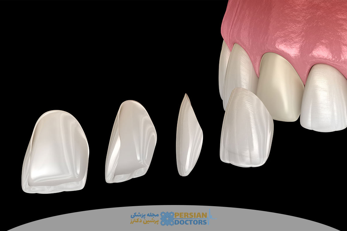 لمینت سه بعدی دندان چیست و چرا به راه حل محبوب زیبایی لبخند تبدیل شده است