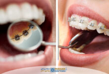 ارتودنسی شفاف بهتر است یا ارتودنسی لینگوال؟ مقایسه کامل هزینه دوام و انتخاب بهترین روش درمانی