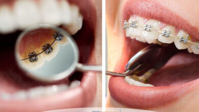 ارتودنسی شفاف بهتر است یا ارتودنسی لینگوال؟ مقایسه کامل هزینه دوام و انتخاب بهترین روش درمانی