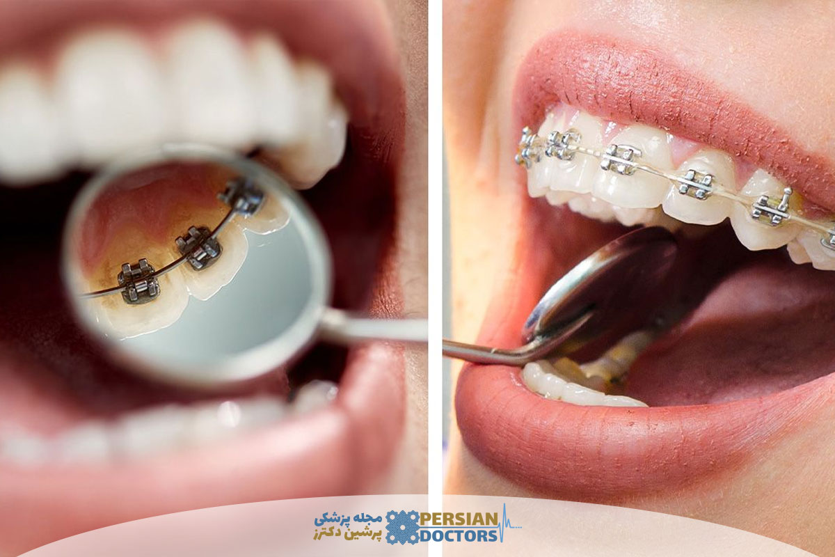 ارتودنسی شفاف بهتر است یا ارتودنسی لینگوال؟ مقایسه کامل هزینه دوام و انتخاب بهترین روش درمانی