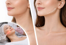 اندولیفت؛ جوانسازی صورت بدون جراحی و بخیه واقعی است؟