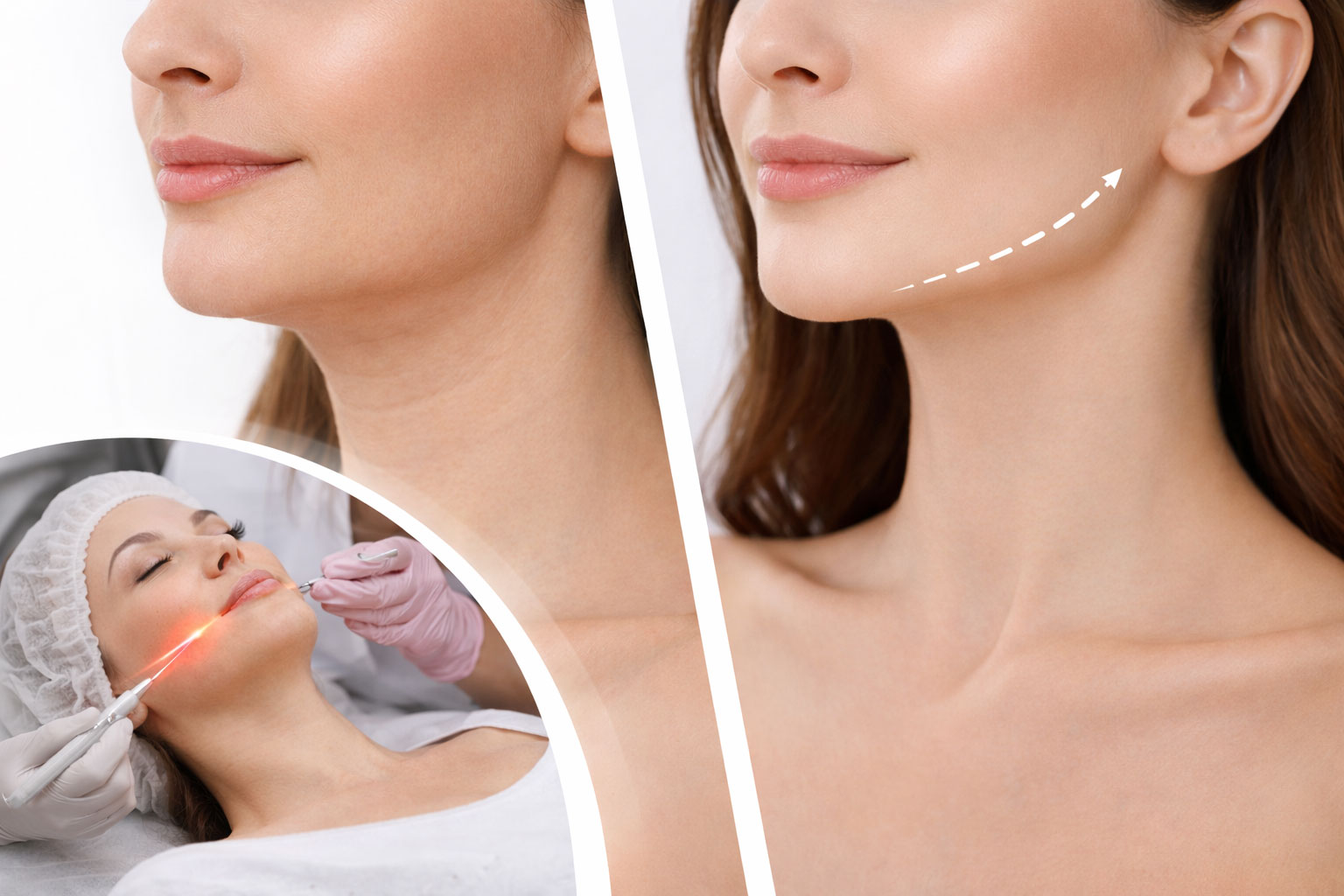 اندولیفت؛ جوانسازی صورت بدون جراحی و بخیه واقعی است؟