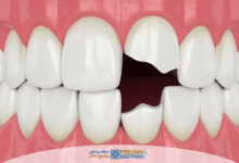 هزینه ترمیم دندان شکسته در سال ۱۴۰۵ چقدر است؟ بررسی کامل قیمت ترمیم دندان در کلینیک های تهران