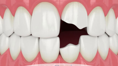 هزینه ترمیم دندان شکسته در سال ۱۴۰۵ چقدر است؟ بررسی کامل قیمت ترمیم دندان در کلینیک های تهران