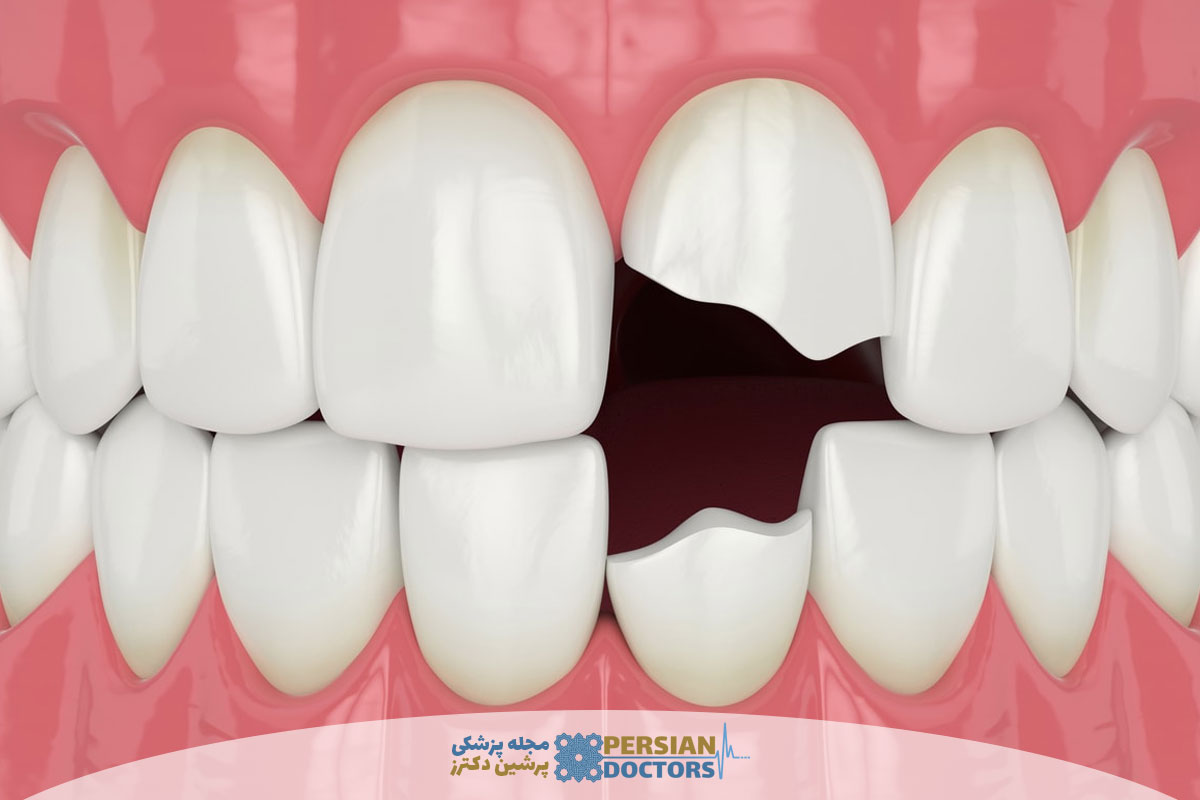هزینه ترمیم دندان شکسته در سال ۱۴۰۵ چقدر است؟ بررسی کامل قیمت ترمیم دندان در کلینیک های تهران