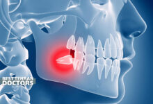 درمان درد دندان عقل نهفته بدون جراحی شامل چه روش هایی است؟